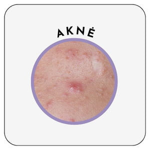 aknė japoniška kosmetika